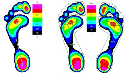 Left: the gait line of my left foot. Right: you can see slight differences in pressure distribution when both of my feet are compared.