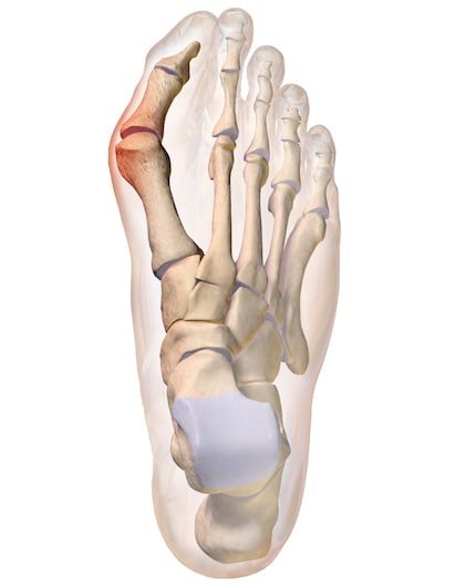 The hallux valgus is a deformity of the first metatarsal.