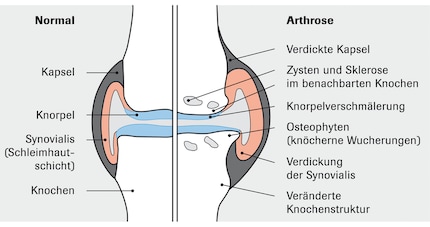 Arthrose im Kniegelenk.
