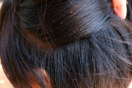 See these lice eggs and nits sticking stubbornly to the hair? They’ve all got to go.